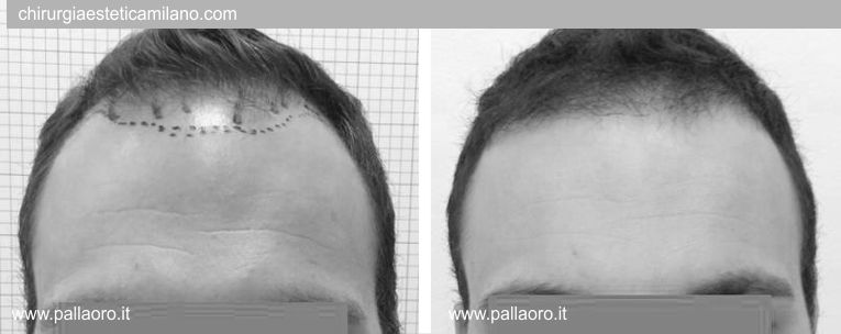 Trapianto capelli: Foto prima e dopo 01