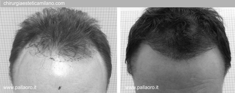 Trapianto capelli: Foto02