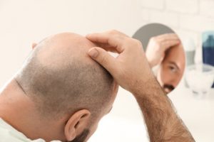 trapianto capelli