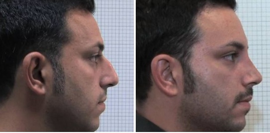 Rinoplastica foto 9: correzione profilo nasale uomo