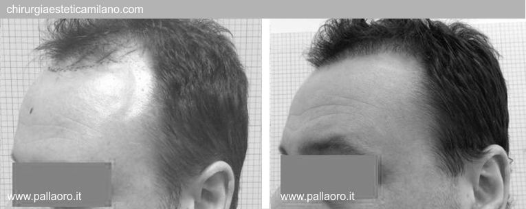 Trapianto capelli: Foto prima e dopo 03